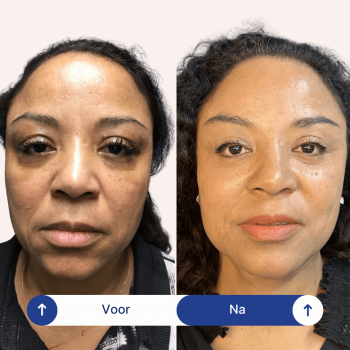 Recht aanzicht van vrouw na facelift